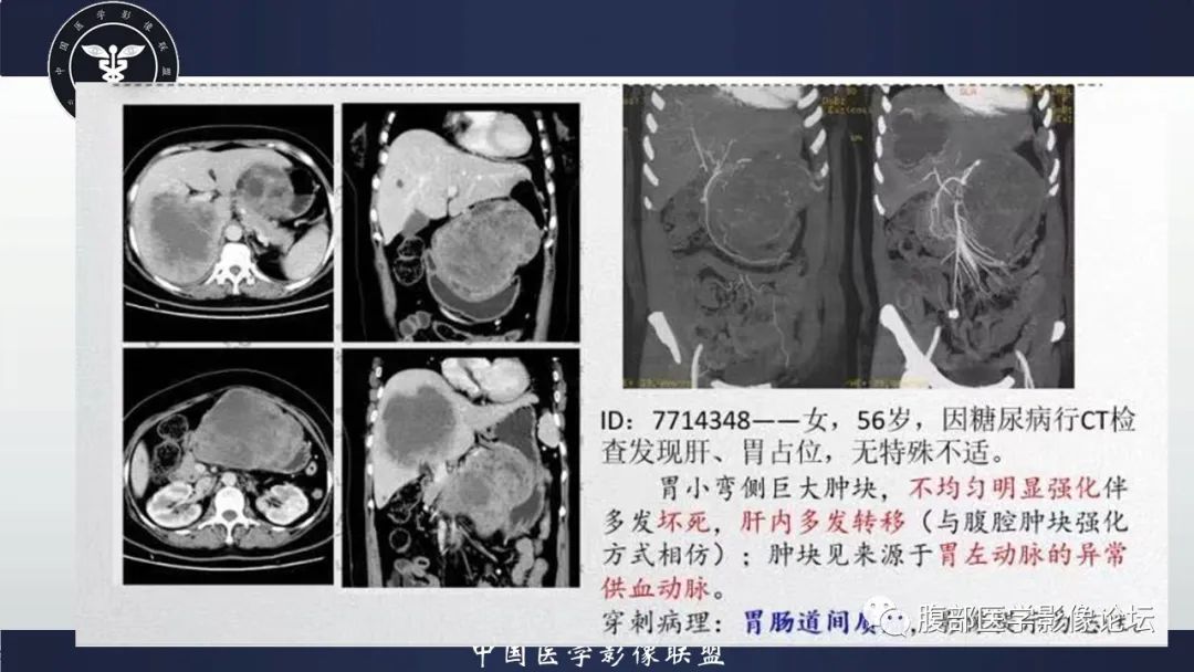 影像PPT - 【PPT】胃肠道间质瘤GIST影像表现-7 影像PPT - 【PPT】胃肠道间质瘤GIST影像表现-7