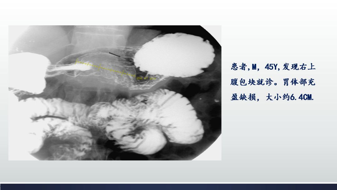 影像PPT - 【PPT】胃肠道间质瘤GIST影像表现-16 影像PPT - 【PPT】胃肠道间质瘤GIST影像表现-16
