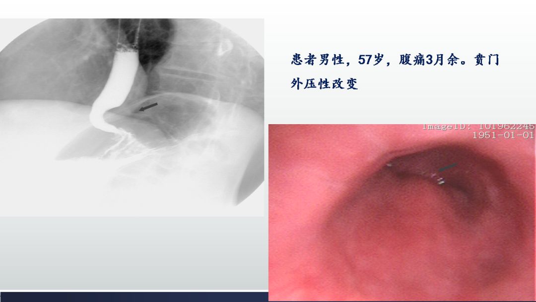 影像PPT - 【PPT】胃肠道间质瘤GIST影像表现-17 影像PPT - 【PPT】胃肠道间质瘤GIST影像表现-17