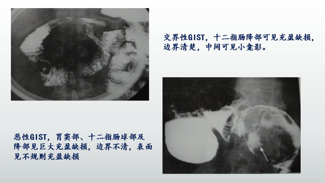 影像PPT - 【PPT】胃肠道间质瘤GIST影像表现-18 影像PPT - 【PPT】胃肠道间质瘤GIST影像表现-18