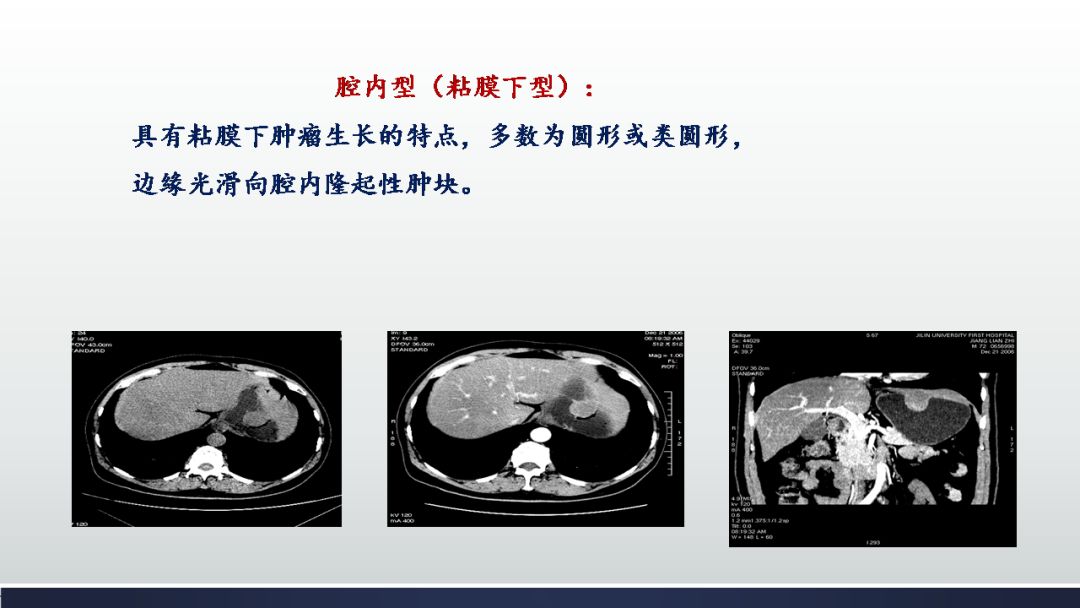 影像PPT - 【PPT】胃肠道间质瘤GIST影像表现-20 影像PPT - 【PPT】胃肠道间质瘤GIST影像表现-20