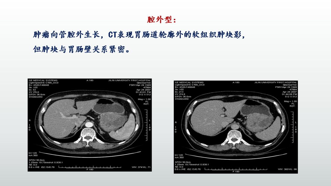 影像PPT - 【PPT】胃肠道间质瘤GIST影像表现-21 影像PPT - 【PPT】胃肠道间质瘤GIST影像表现-21