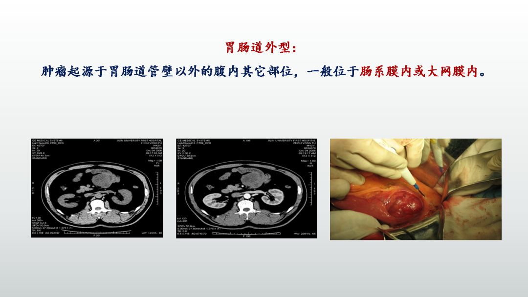 影像PPT - 【PPT】胃肠道间质瘤GIST影像表现-23 影像PPT - 【PPT】胃肠道间质瘤GIST影像表现-23