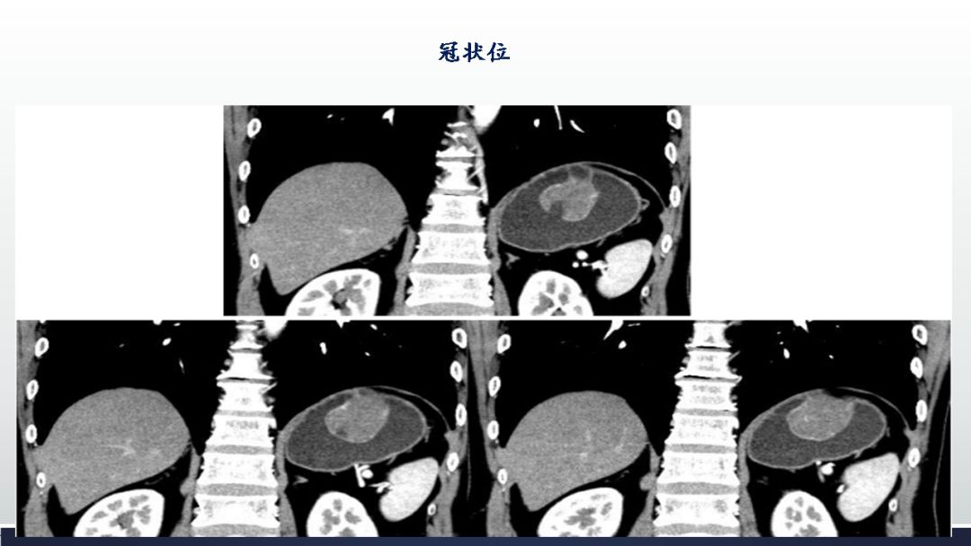 影像PPT - 【PPT】胃肠道间质瘤GIST影像表现-27 影像PPT - 【PPT】胃肠道间质瘤GIST影像表现-27