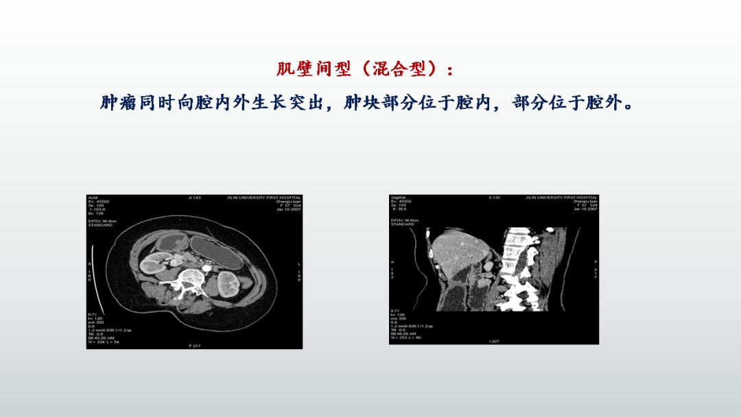影像PPT - 【PPT】胃肠道间质瘤GIST影像表现-22 影像PPT - 【PPT】胃肠道间质瘤GIST影像表现-22