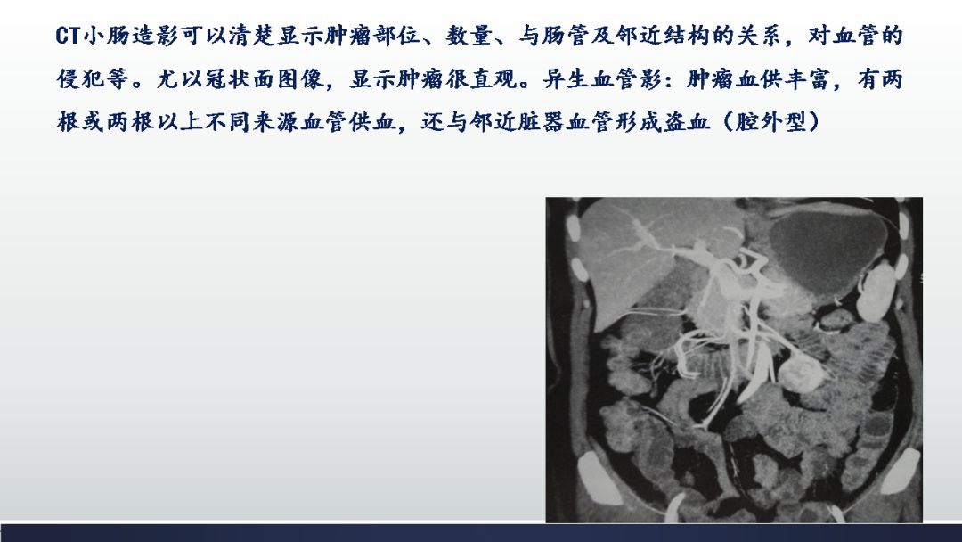 影像PPT - 【PPT】胃肠道间质瘤GIST影像表现-32 影像PPT - 【PPT】胃肠道间质瘤GIST影像表现-32