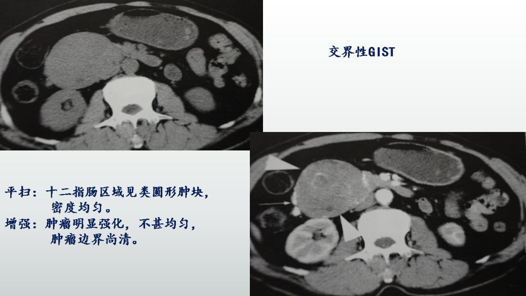影像PPT - 【PPT】胃肠道间质瘤GIST影像表现-29 影像PPT - 【PPT】胃肠道间质瘤GIST影像表现-29