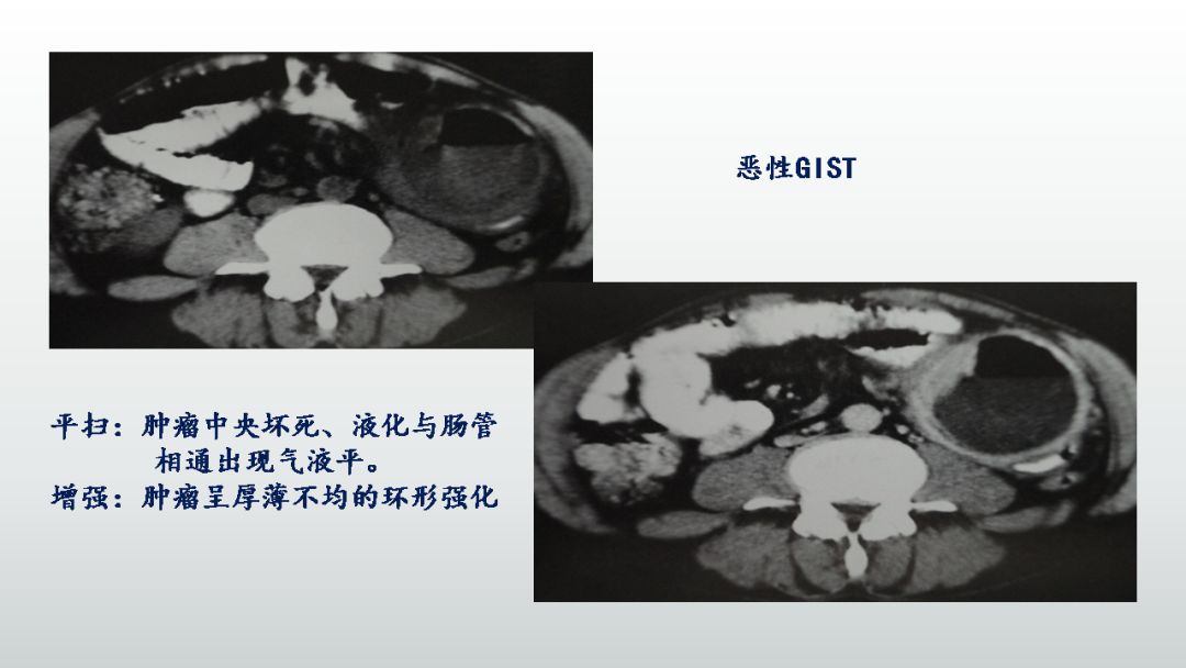影像PPT - 【PPT】胃肠道间质瘤GIST影像表现-30 影像PPT - 【PPT】胃肠道间质瘤GIST影像表现-30