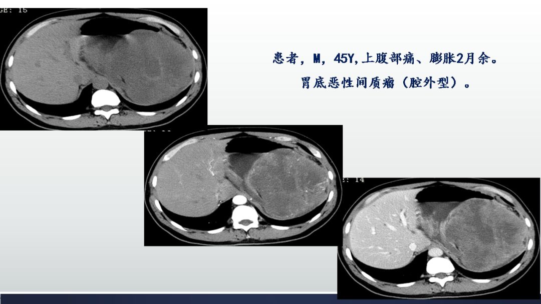 影像PPT - 【PPT】胃肠道间质瘤GIST影像表现-35 影像PPT - 【PPT】胃肠道间质瘤GIST影像表现-35