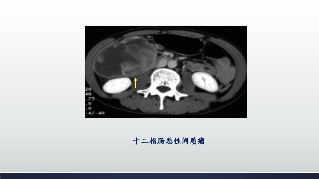 影像PPT - 【PPT】胃肠道间质瘤GIST影像表现-37 影像PPT - 【PPT】胃肠道间质瘤GIST影像表现-37