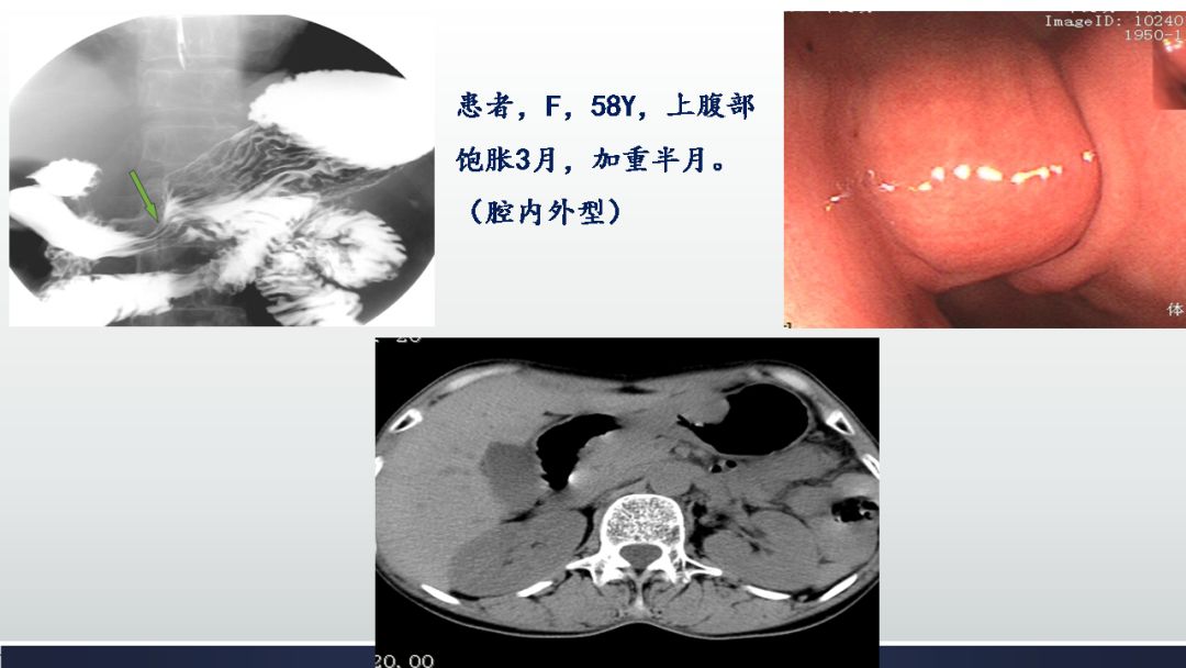 影像PPT - 【PPT】胃肠道间质瘤GIST影像表现-34 影像PPT - 【PPT】胃肠道间质瘤GIST影像表现-34