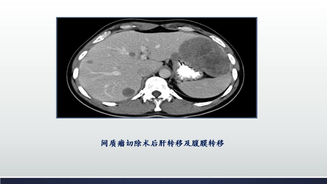 影像PPT - 【PPT】胃肠道间质瘤GIST影像表现-39 影像PPT - 【PPT】胃肠道间质瘤GIST影像表现-39