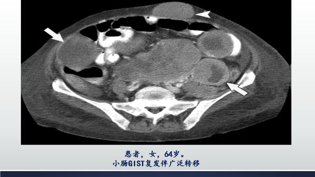 影像PPT - 【PPT】胃肠道间质瘤GIST影像表现-44 影像PPT - 【PPT】胃肠道间质瘤GIST影像表现-44