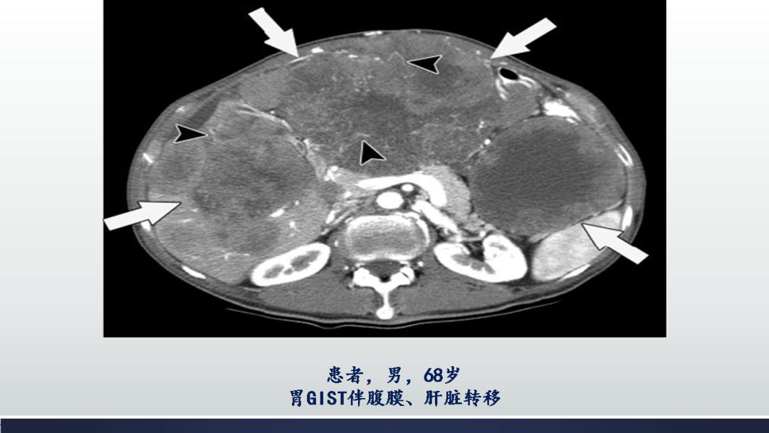 影像PPT - 【PPT】胃肠道间质瘤GIST影像表现-45 影像PPT - 【PPT】胃肠道间质瘤GIST影像表现-45