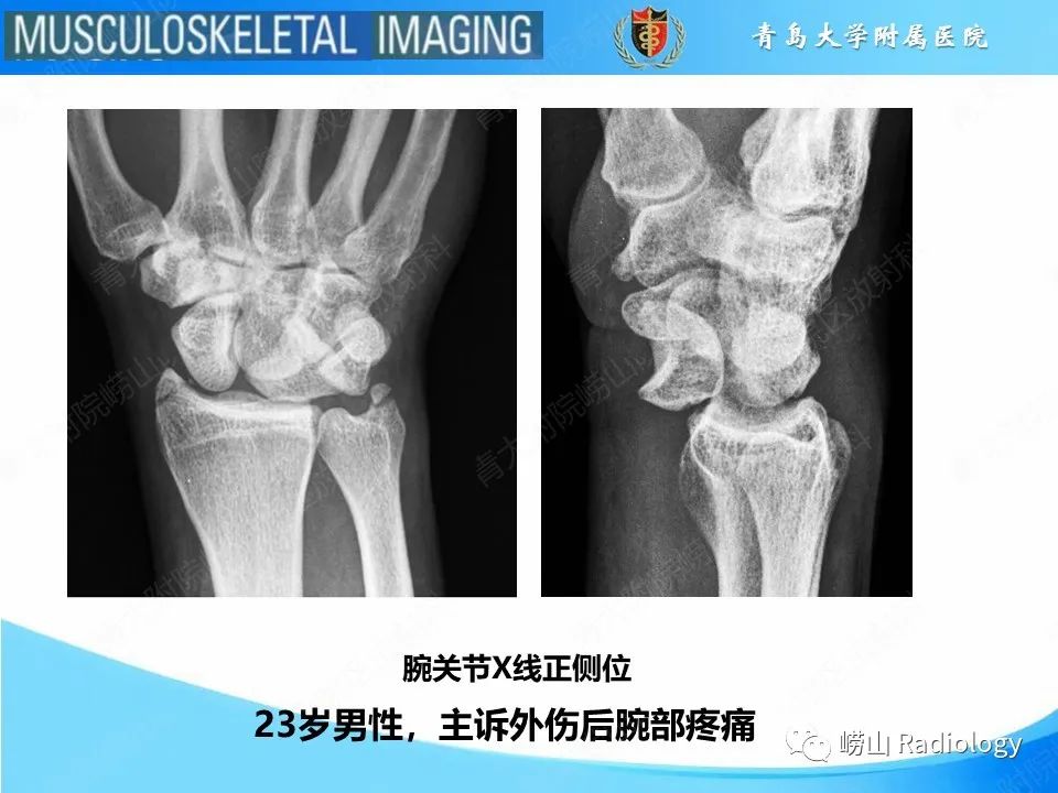 影像PPT - 【PPT】月骨脱位-2