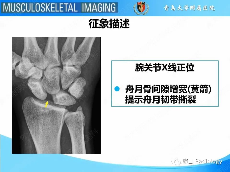影像PPT - 【PPT】月骨脱位-9