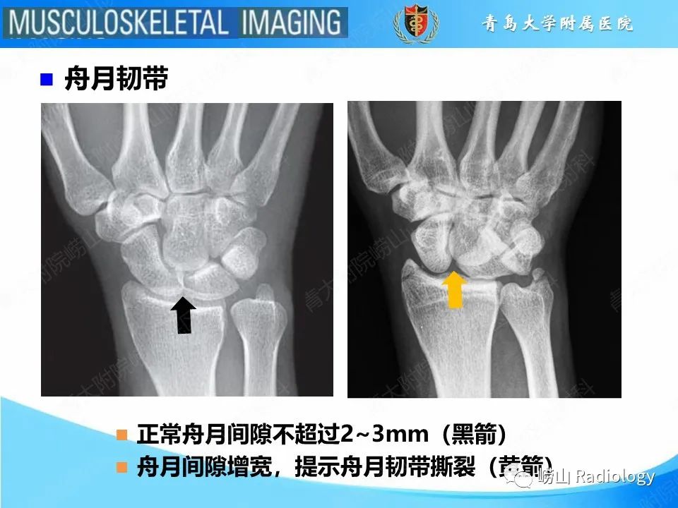 影像PPT - 【PPT】月骨脱位-8