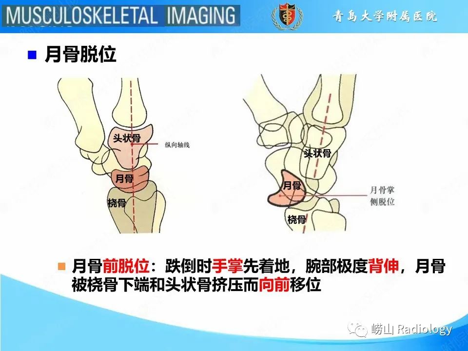 影像PPT - 【PPT】月骨脱位-11