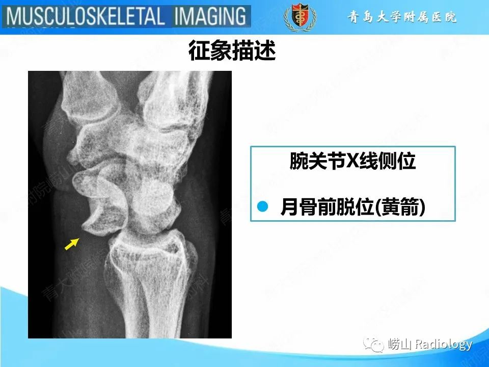 影像PPT - 【PPT】月骨脱位-12