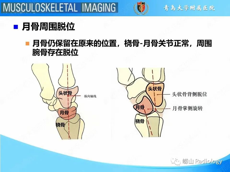 影像PPT - 【PPT】月骨脱位-14