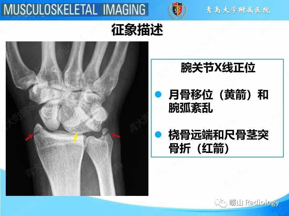 影像PPT - 【PPT】月骨脱位-13