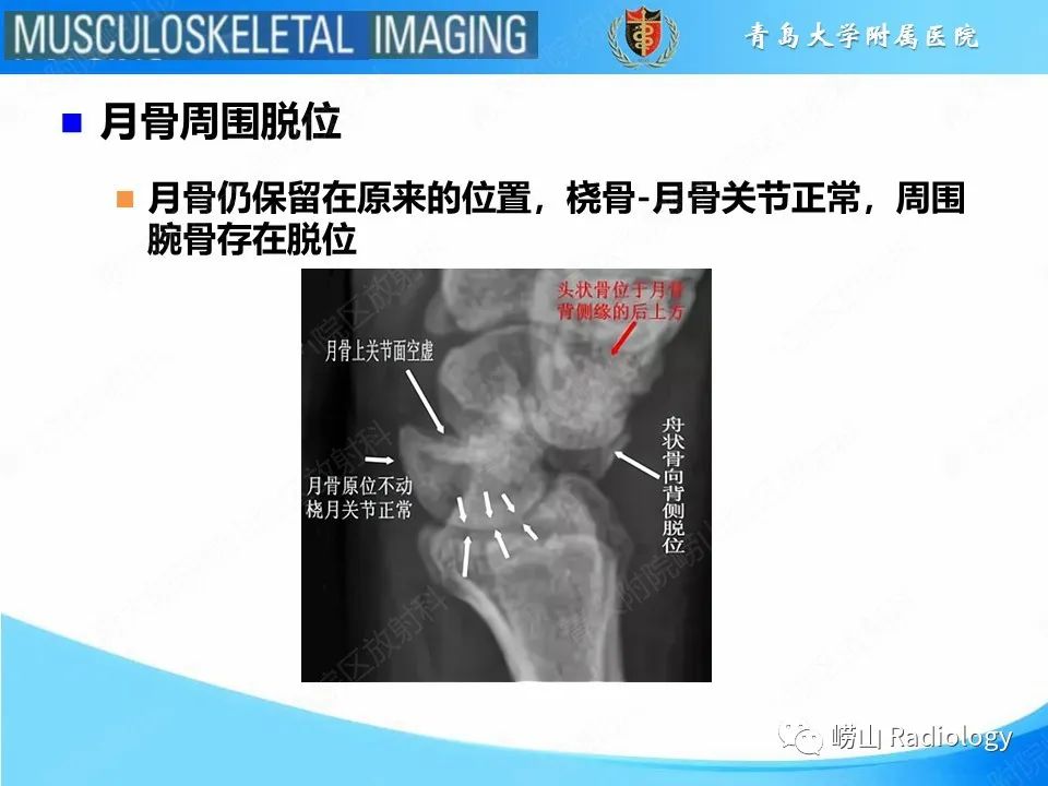 影像PPT - 【PPT】月骨脱位-15