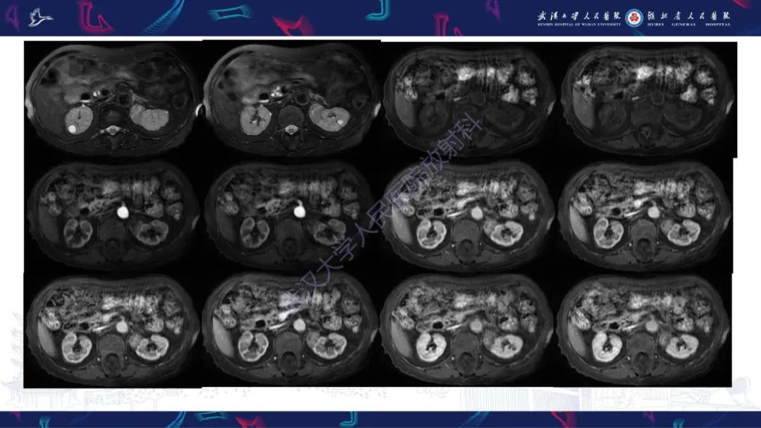 影像PPT - 【PPT】肾嫌色细胞癌影像诊断-6