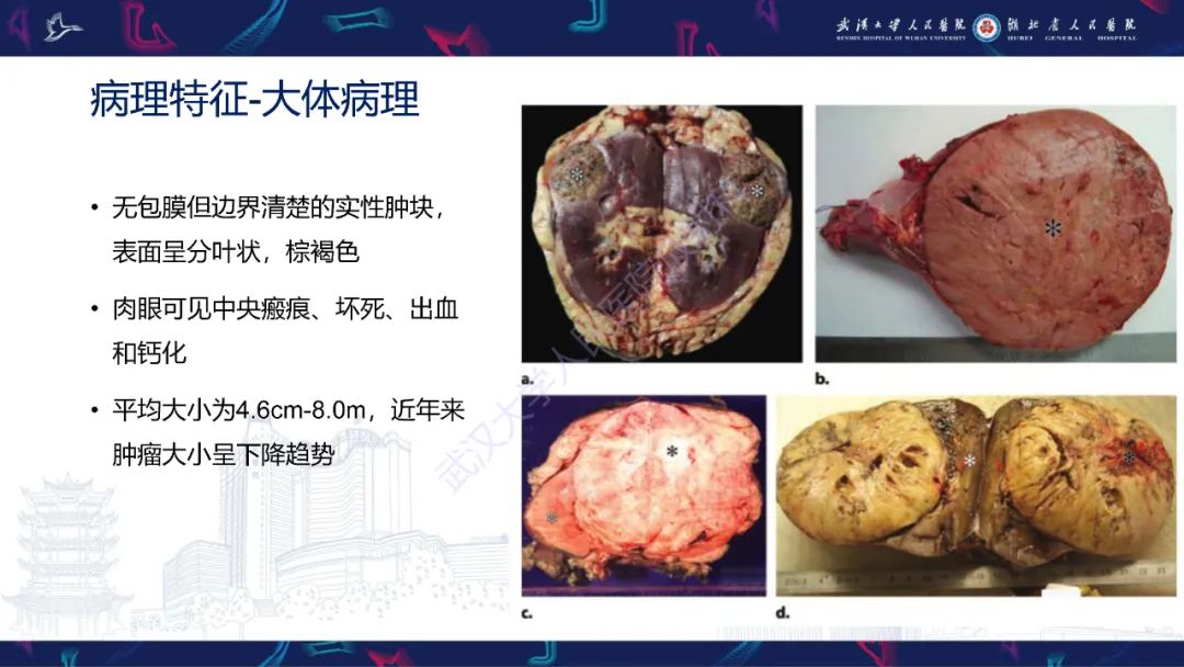 影像PPT - 【PPT】肾嫌色细胞癌影像诊断-9