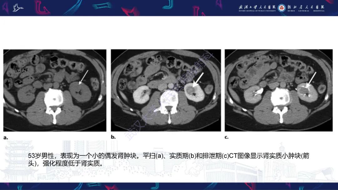 影像PPT - 【PPT】肾嫌色细胞癌影像诊断-12