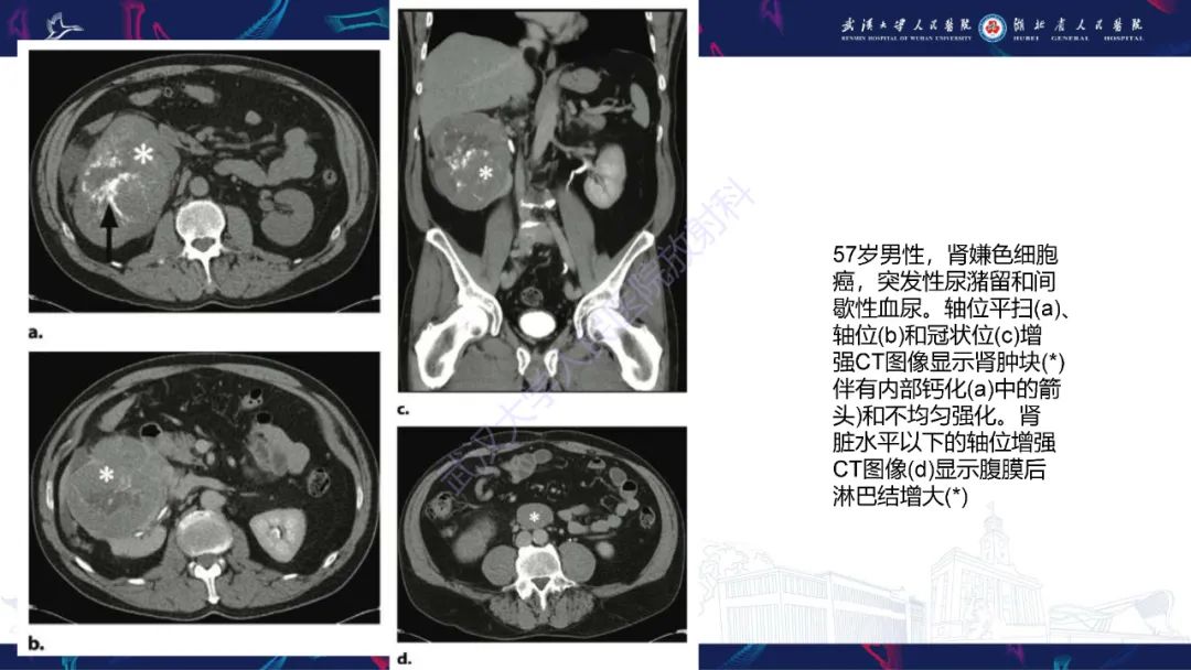 影像PPT - 【PPT】肾嫌色细胞癌影像诊断-14