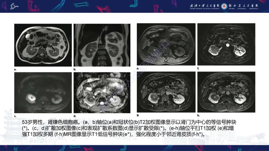 影像PPT - 【PPT】肾嫌色细胞癌影像诊断-16