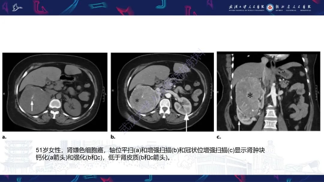 影像PPT - 【PPT】肾嫌色细胞癌影像诊断-15