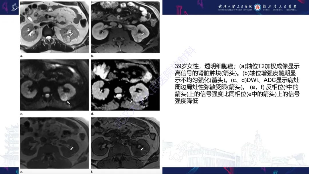 影像PPT - 【PPT】肾嫌色细胞癌影像诊断-19