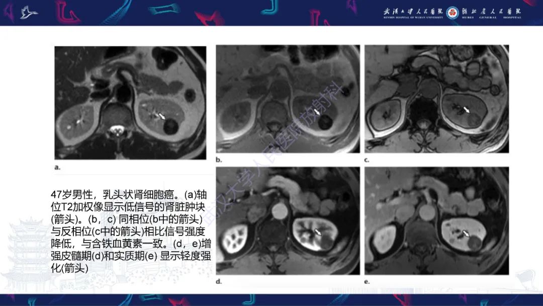 影像PPT - 【PPT】肾嫌色细胞癌影像诊断-21
