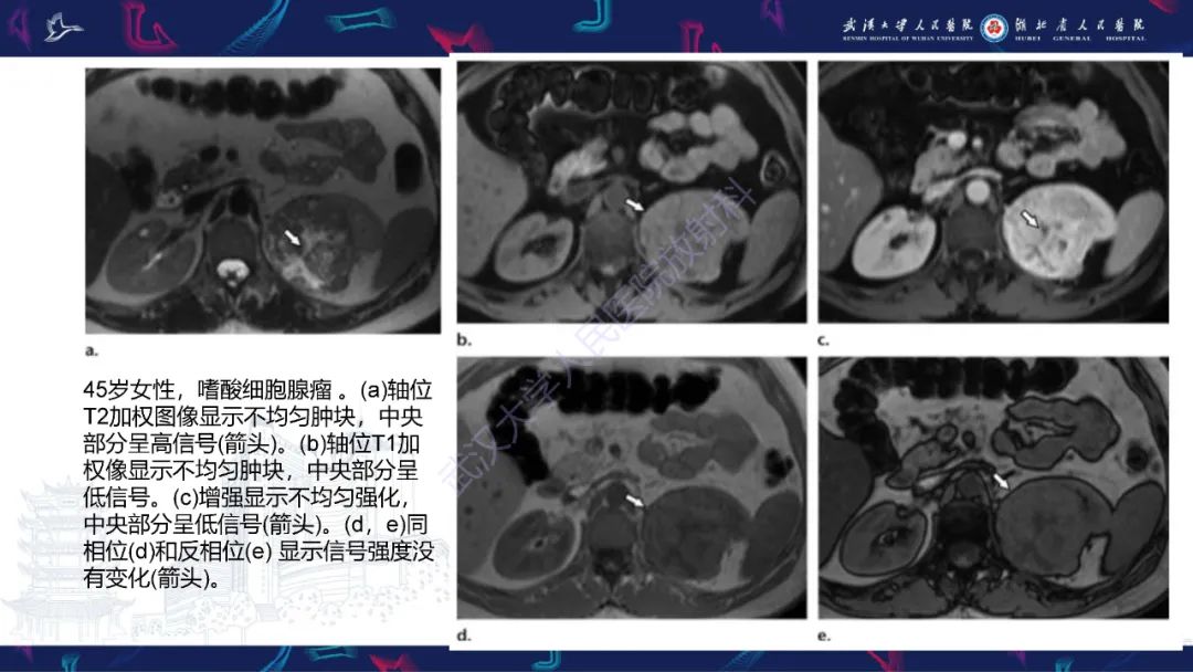 影像PPT - 【PPT】肾嫌色细胞癌影像诊断-25