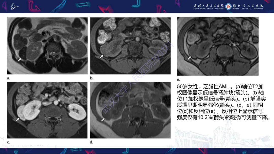 影像PPT - 【PPT】肾嫌色细胞癌影像诊断-2