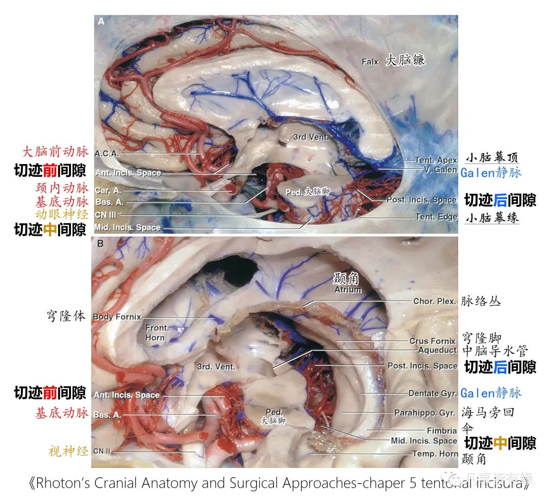 影像PPT - 小脑幕切迹间隙-2 影像PPT - 小脑幕切迹间隙-2