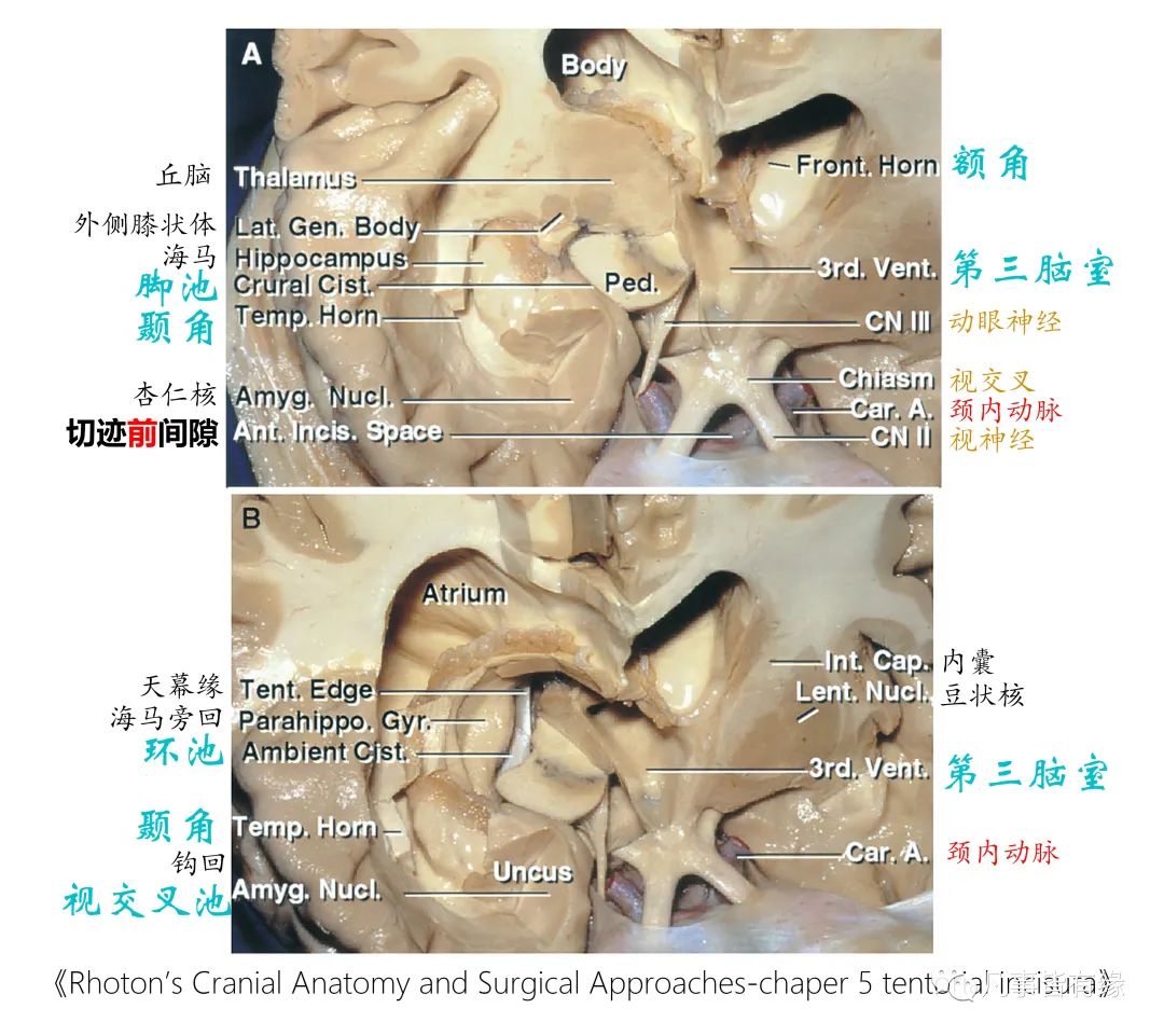 影像PPT - 小脑幕切迹间隙-5 影像PPT - 小脑幕切迹间隙-5