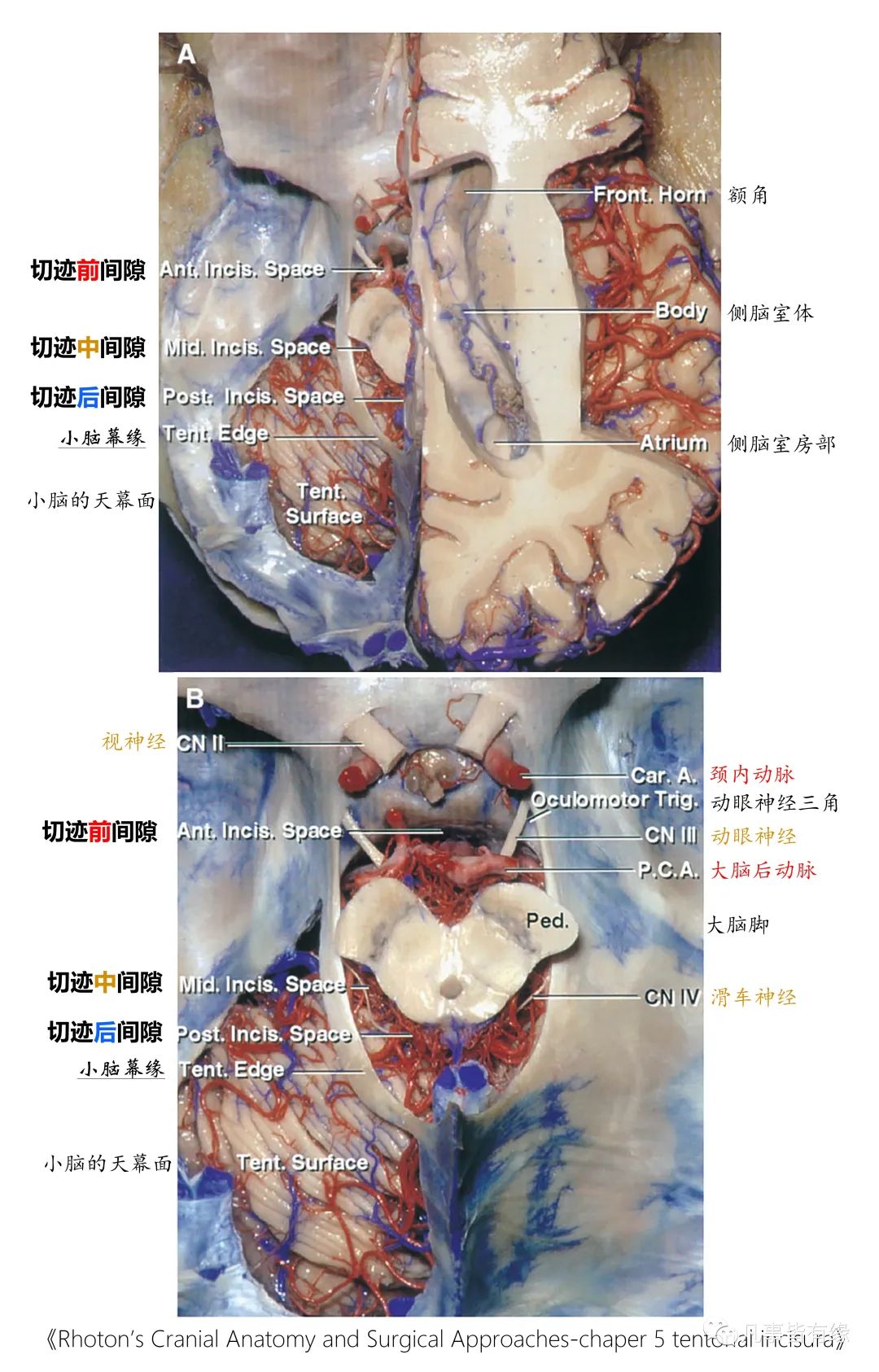 影像PPT - 小脑幕切迹间隙-3 影像PPT - 小脑幕切迹间隙-3