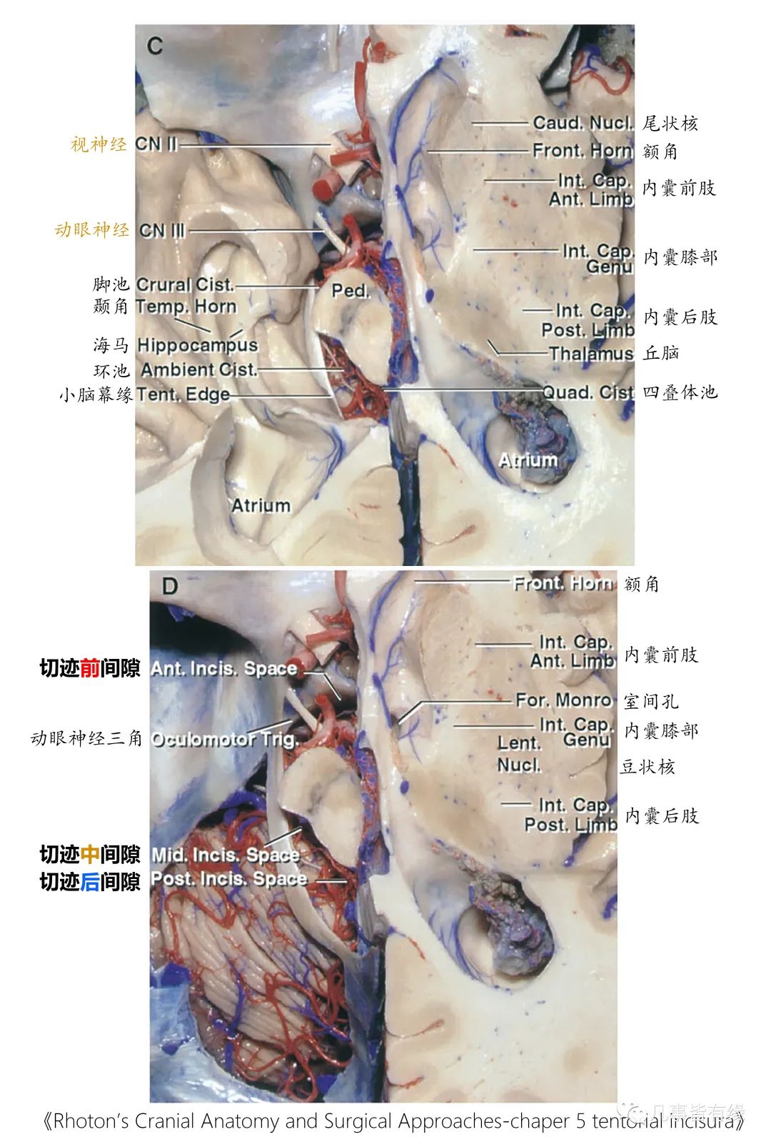 影像PPT - 小脑幕切迹间隙-4 影像PPT - 小脑幕切迹间隙-4