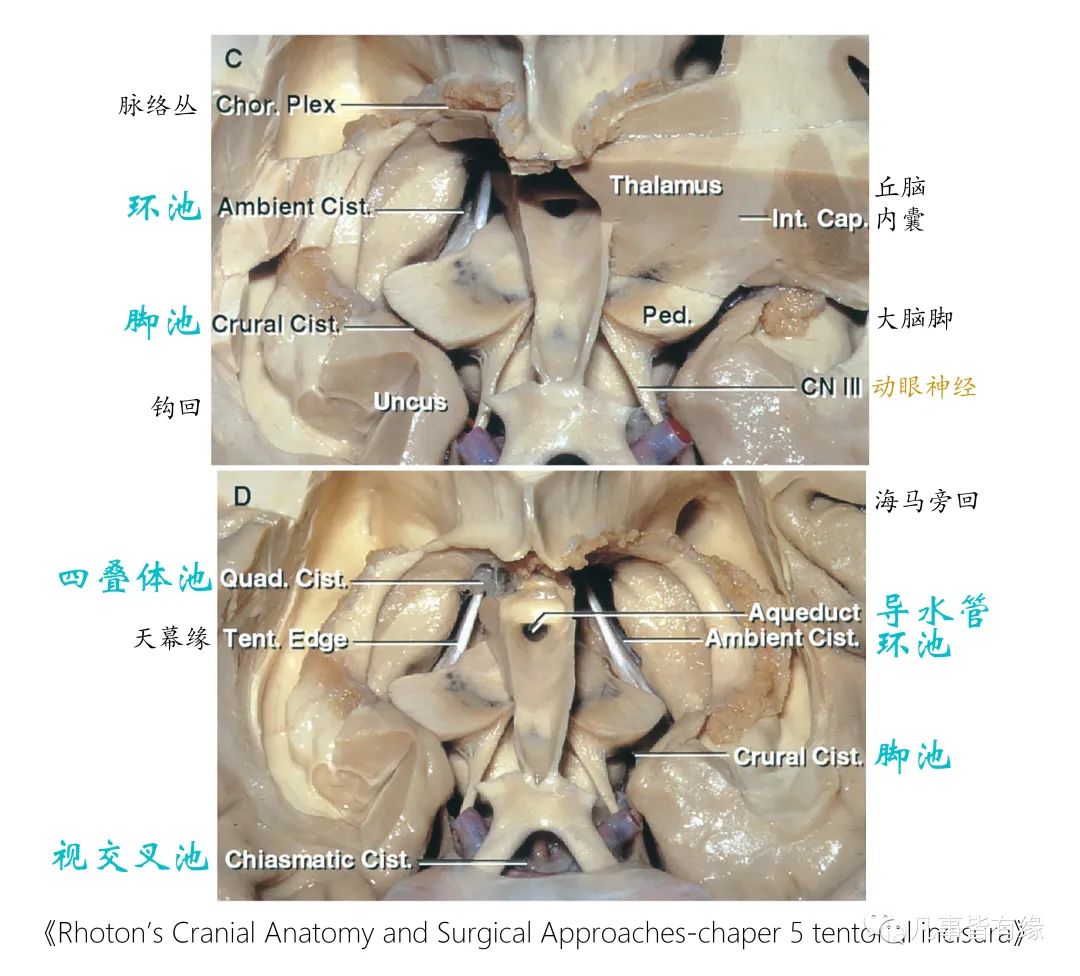 影像PPT - 小脑幕切迹间隙-6 影像PPT - 小脑幕切迹间隙-6