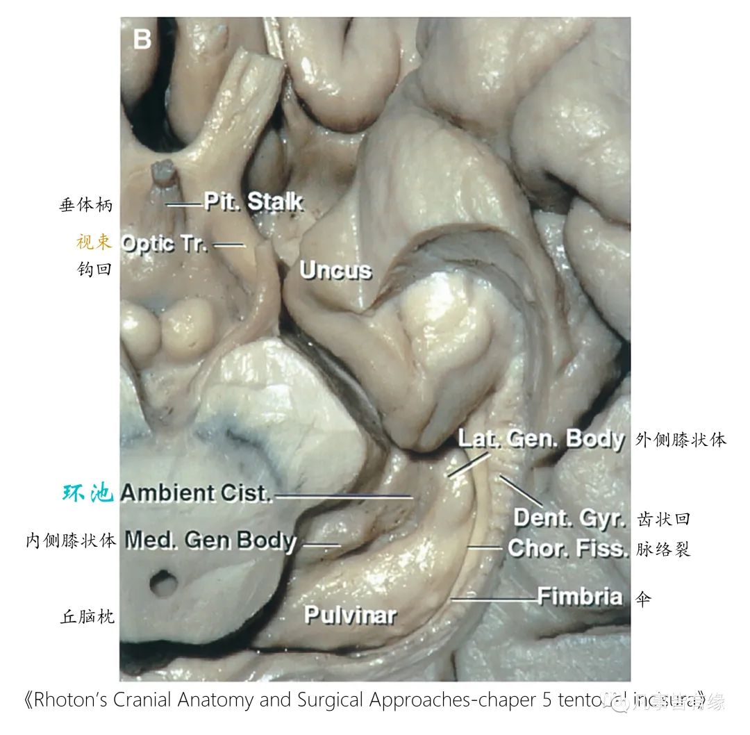 影像PPT - 小脑幕切迹间隙-8 影像PPT - 小脑幕切迹间隙-8