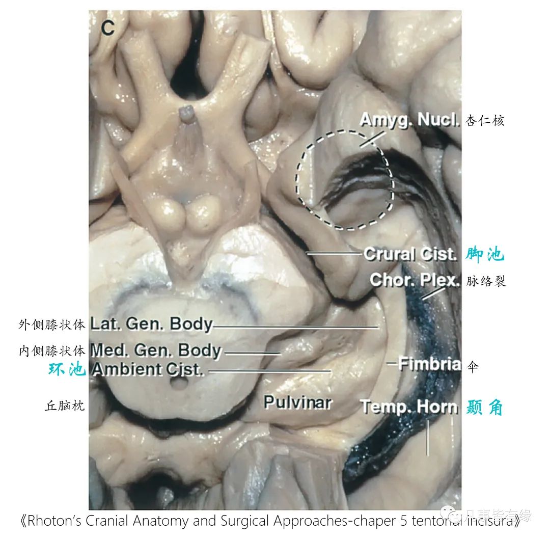 影像PPT - 小脑幕切迹间隙-9 影像PPT - 小脑幕切迹间隙-9