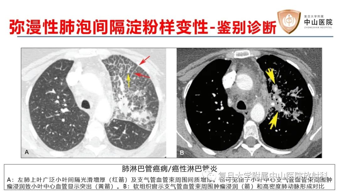 影像PPT - 【病例】肺淀粉样变性两例CT影像-22