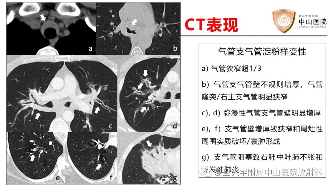 影像PPT - 【病例】肺淀粉样变性两例CT影像-24