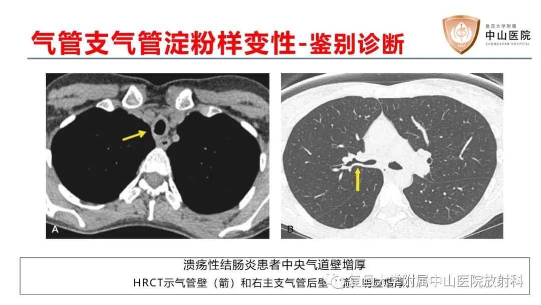 影像PPT - 【病例】肺淀粉样变性两例CT影像-27