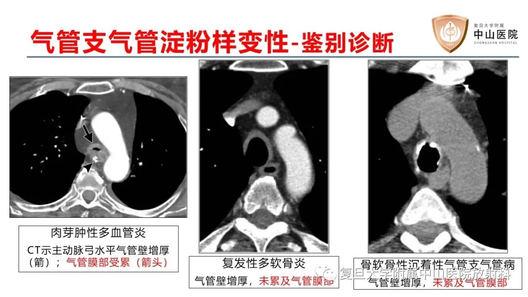 影像PPT - 【病例】肺淀粉样变性两例CT影像-26