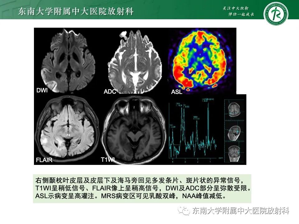 影像PPT - 【PPT】线粒体脑肌病伴高乳酸血症和卒中样发作-3