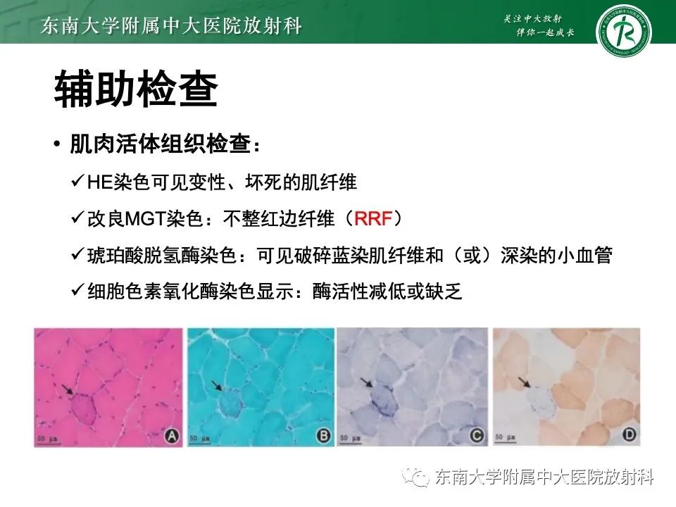 影像PPT - 【PPT】线粒体脑肌病伴高乳酸血症和卒中样发作-14