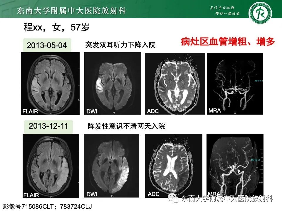 影像PPT - 【PPT】线粒体脑肌病伴高乳酸血症和卒中样发作-22